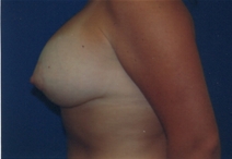 Breast Lift After Photo by Lawrence Gray, MD; Portsmouth, NH - Case 23244