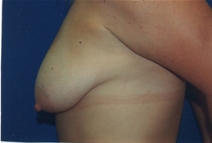 Breast Lift Before Photo by Lawrence Gray, MD; Portsmouth, NH - Case 23244