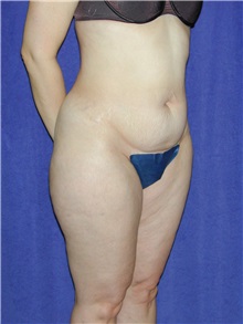 Tummy Tuck Before Photo by Geoffrey Leber, MD, FACS; Scottsdale, AZ - Case 28651