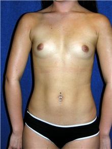 Breast Augmentation Before Photo by Geoffrey Leber, MD, FACS; Scottsdale, AZ - Case 28653