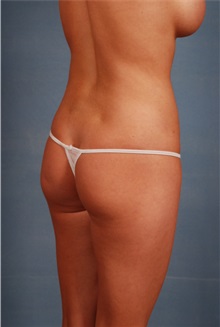 Liposuction After Photo by Geoffrey Leber, MD, FACS; Scottsdale, AZ - Case 28655