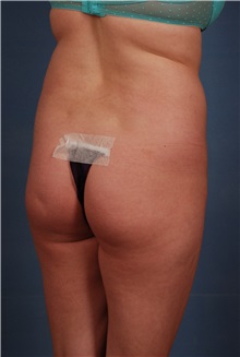 Liposuction Before Photo by Geoffrey Leber, MD, FACS; Scottsdale, AZ - Case 28655