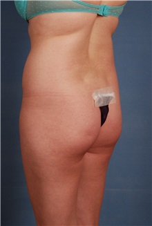 Liposuction Before Photo by Geoffrey Leber, MD, FACS; Scottsdale, AZ - Case 28655