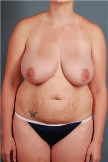 Breast Lift Before Photo by Geoffrey Leber, MD, FACS; Scottsdale, AZ - Case 28657