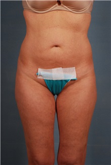 Tummy Tuck Before Photo by Geoffrey Leber, MD, FACS; Scottsdale, AZ - Case 28659
