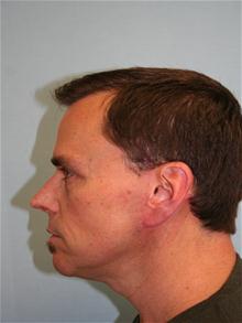 Facelift After Photo by Richard Busby, MD; Portland, OR - Case 25842