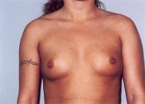 Breast Augmentation Before Photo by Richard Busby, MD; Portland, OR - Case 9605