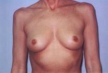Breast Augmentation Before Photo by Richard Busby, MD; Portland, OR - Case 9606