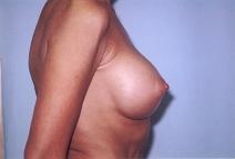 Breast Augmentation After Photo by Richard Busby, MD; Portland, OR - Case 9606