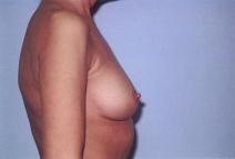 Breast Augmentation Before Photo by Richard Busby, MD; Portland, OR - Case 9606