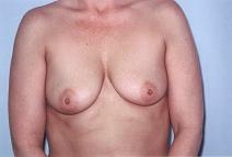 Breast Augmentation Before Photo by Richard Busby, MD; Portland, OR - Case 9608