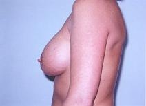 Breast Augmentation After Photo by Richard Busby, MD; Portland, OR - Case 9608
