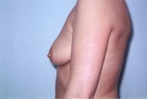 Breast Augmentation Before Photo by Richard Busby, MD; Portland, OR - Case 9608