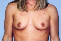 Breast Augmentation Before Photo by Richard Busby, MD; Portland, OR - Case 9609