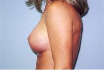 Breast Augmentation After Photo by Richard Busby, MD; Portland, OR - Case 9609