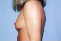 Breast Augmentation Before Photo by Richard Busby, MD; Portland, OR - Case 9609