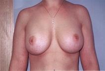 Breast Augmentation After Photo by Richard Busby, MD; Portland, OR - Case 9611