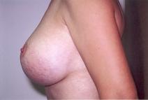 Breast Augmentation After Photo by Richard Busby, MD; Portland, OR - Case 9611
