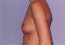 Breast Augmentation Before Photo by Richard Busby, MD; Portland, OR - Case 9611