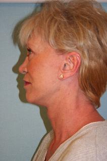 Facelift After Photo by Richard Busby, MD; Portland, OR - Case 9667