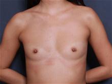 Breast Augmentation Before Photo by John Smoot, MD; La Jolla, CA - Case 27312