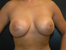 Breast Augmentation After Photo by John Smoot, MD; La Jolla, CA - Case 27313