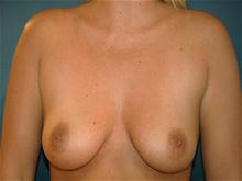 Breast Augmentation Before Photo by John Smoot, MD; La Jolla, CA - Case 27313