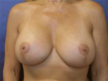 Breast Augmentation After Photo by John Smoot, MD; La Jolla, CA - Case 27378