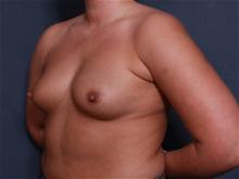 Breast Augmentation Before Photo by John Smoot, MD; La Jolla, CA - Case 27379
