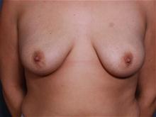 Breast Augmentation Before Photo by John Smoot, MD; La Jolla, CA - Case 27382