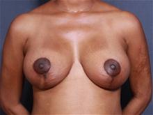 Breast Lift After Photo by John Smoot, MD; La Jolla, CA - Case 27567
