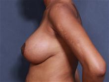 Breast Lift After Photo by John Smoot, MD; La Jolla, CA - Case 27567