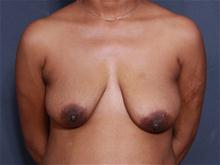 Breast Lift Before Photo by John Smoot, MD; La Jolla, CA - Case 27572