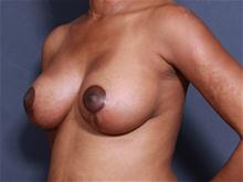 Breast Lift After Photo by John Smoot, MD; La Jolla, CA - Case 27572