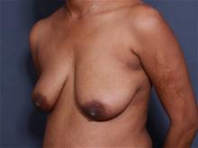 Breast Lift Before Photo by John Smoot, MD; La Jolla, CA - Case 27572