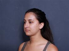 Liposuction After Photo by John Smoot, MD; La Jolla, CA - Case 27574