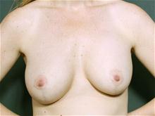 Breast Lift After Photo by John Smoot, MD; La Jolla, CA - Case 27582