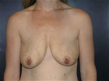 Breast Lift Before Photo by John Smoot, MD; La Jolla, CA - Case 27582
