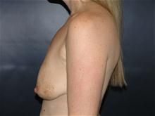 Breast Lift Before Photo by John Smoot, MD; La Jolla, CA - Case 27582