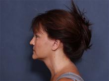 Facelift After Photo by John Smoot, MD; La Jolla, CA - Case 27583
