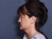 Facelift Before Photo by John Smoot, MD; La Jolla, CA - Case 27583