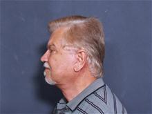 Facelift After Photo by John Smoot, MD; La Jolla, CA - Case 27647