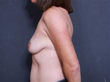 Breast Lift Before Photo by John Smoot, MD; La Jolla, CA - Case 27651
