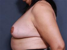 Breast Reduction After Photo by John Smoot, MD; La Jolla, CA - Case 27652