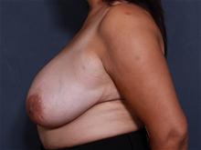Breast Reduction Before Photo by John Smoot, MD; La Jolla, CA - Case 27652