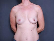 Breast Augmentation Before Photo by John Smoot, MD; La Jolla, CA - Case 27653