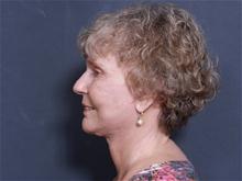 Facelift After Photo by John Smoot, MD; La Jolla, CA - Case 27656