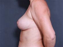 Breast Lift After Photo by John Smoot, MD; La Jolla, CA - Case 27657