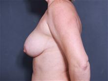 Breast Lift Before Photo by John Smoot, MD; La Jolla, CA - Case 27657
