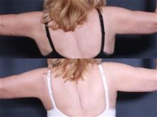 Arm Lift After Photo by John Smoot, MD; La Jolla, CA - Case 27658